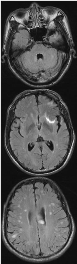중추신경계 탈수초질환으로 오인된 림프종 3예 A B C Figure 2. Brain MRI and pathologic findings for case 2.