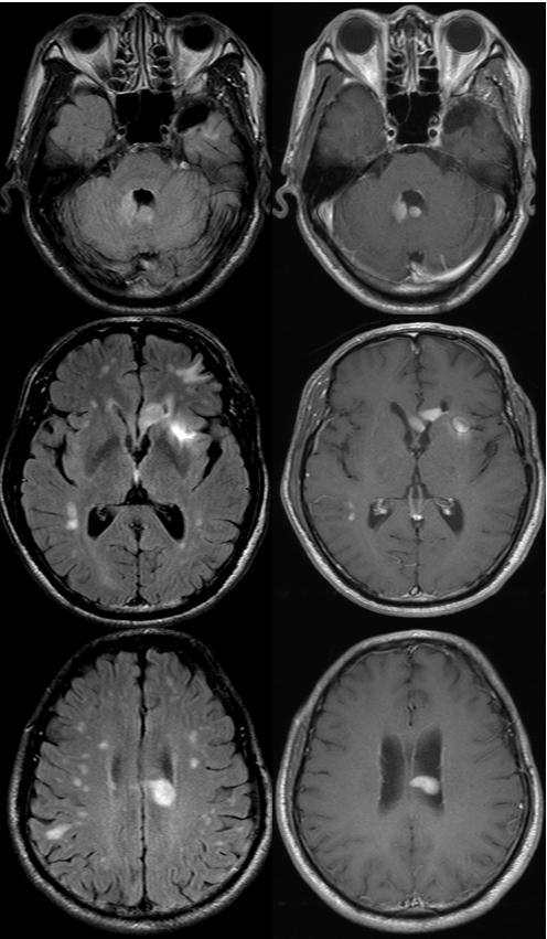 (B) Follow-up MRI showed multiple small enhancing lesions in right cerebellum, right temporal subcortex and left corpus callosum.