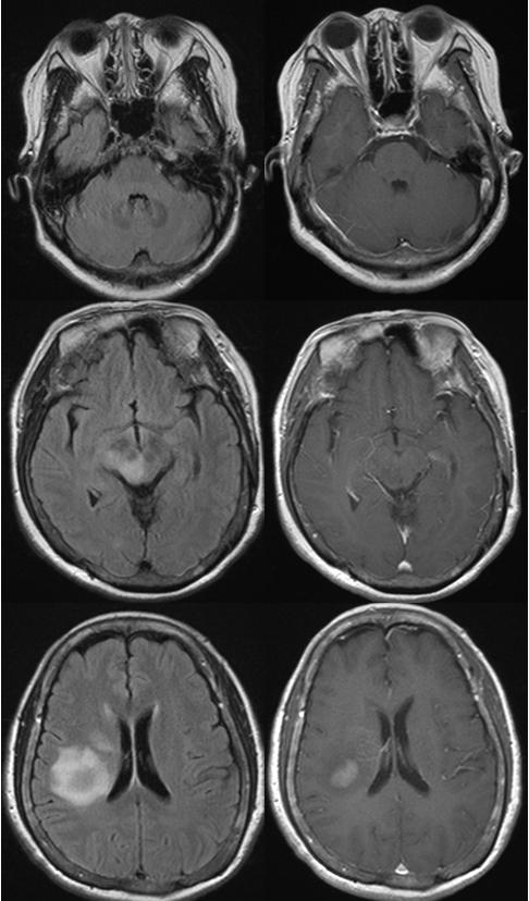 박형준 신하영 이형석 유한수 김승민 A C B Figure 3. Brain MRI and pathologic findings for case 3.