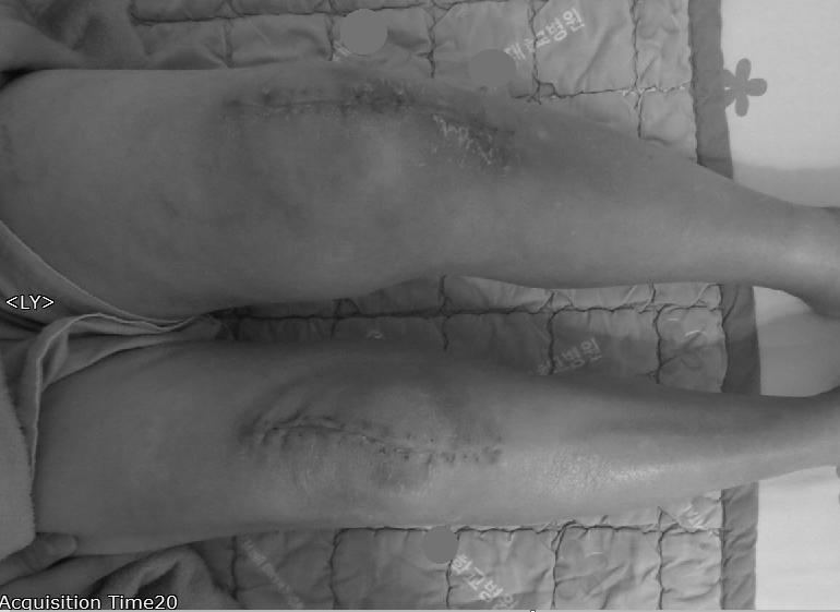 김창곤 고낙용 고연석 이정한 Fig. 1. Swelling of the left upper and lower leg. 둘레가우측보다 2 cm 이상의차이가확인되었으며 (Fig. 1), 좌측족관절을강하게신전시키고슬관절및고관절을신전했을때종아리에통증이나타나는 Homan sign 양성반응이관찰되었다. 고령 (74세) 및비만 ( 신체질량지수 : 32.