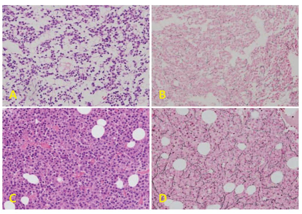 Korean J Clin Lab Sci. Vol. 48, No. 4, December 2016 373 (Ventana)를 사용하였으며 Bench Mark XT 자동염색기(Ventana) 염색을 시행하였다. 골수 조직 내 세망섬유의 경우 발현양에 따라 장비로 시행하였다.