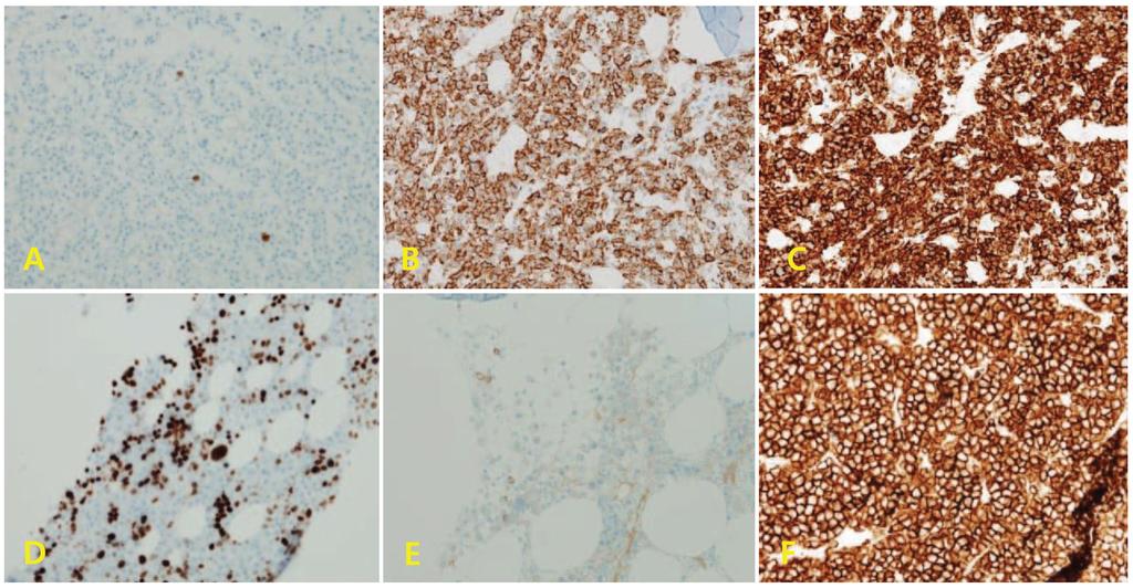 374 Ji Young Park and Kyung Hee Han. Decalcification Methods of Bone Marrow Biopsy 회용액에 처리한 후 염색을 시행한 16 예 모두에서도 뚜렷한 양성 로 처리한 경우에는 면역조직화학염색에서의 결과와 동일한 kappa 염색상이 관찰되었다(Table 3, Fig. 2).