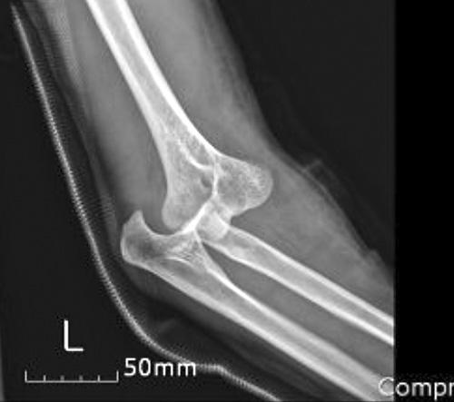(A) Initial plain x-rays show posteromedial elbow dislocation, (B) displaced and