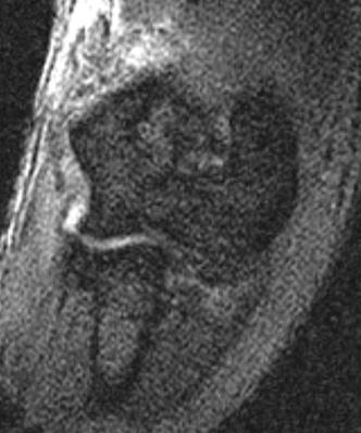 도수 정복 후 촬영한 방사선 사진상 주관절은 정복되었으나 측면 사진에서 척골과 상완골의 관절 간격이 6 mm 정도 벌어져 있는 것이 관찰되었다.