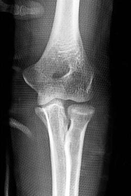 Medial collateral ligament and the soft tissue of the elbow was treated