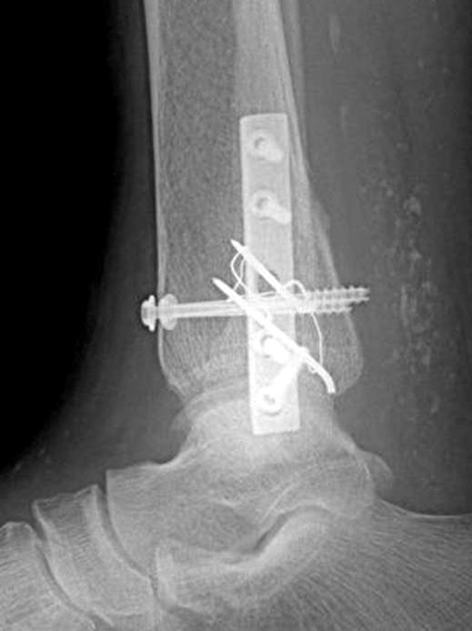 22 이재성, 이한준, 유재현, 김희천 Fig. 5. This photo shows completion of definite fixation. The medial malleolar fracture was reduced by non absorbable suture. Table 1.