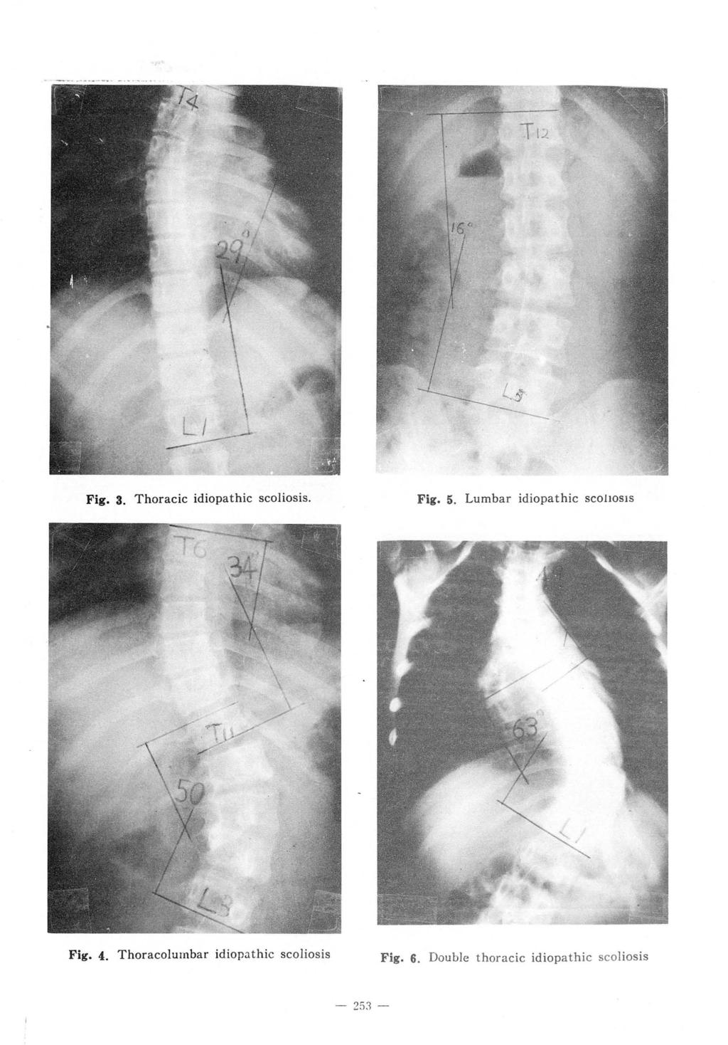 Fig. 3. Thoracic idiopathic scoliosis. Fig. 5. Lumbar idiopathic SCOl losis / x?