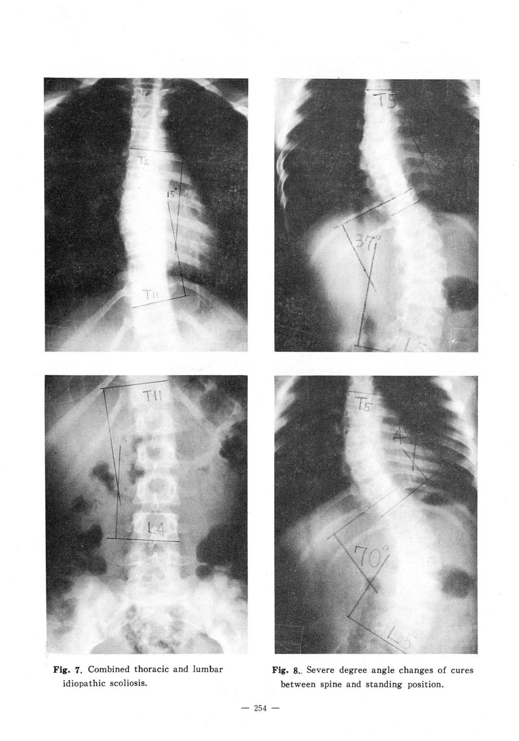 Fig. 7. and lumba r idiopa thic scoliosis. Fig. 8.