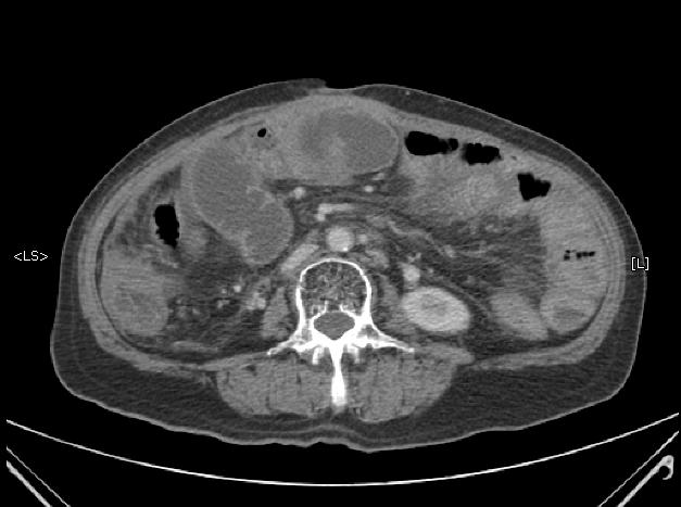 showed A-loop with transition zone near gastrojejunostomy site(suspicious A-loop