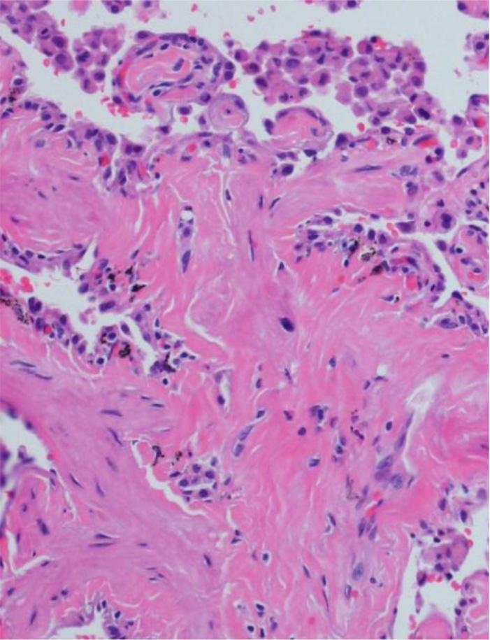 병리 소견은 저배율상 미 에 간유리 음영(ground-glass opacities)이 관찰되며, 경도의 폐 만성 폐기종 소견과 함께 폐포 중격(alveolar septum)의 비후 기종과 미만성 기관지 확장증 소견이 관찰되어 간질성 폐질 가