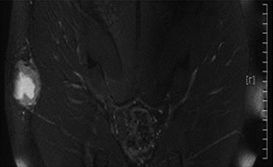 Echogenicity: anechoic, hypoechoic, isoechoic, hyperechoic, mixed (compared with subcutaneous fat) Margin Well-defined, ill-defined Shape Round, oval, lobulated, irregular Effect on ultrasound beam