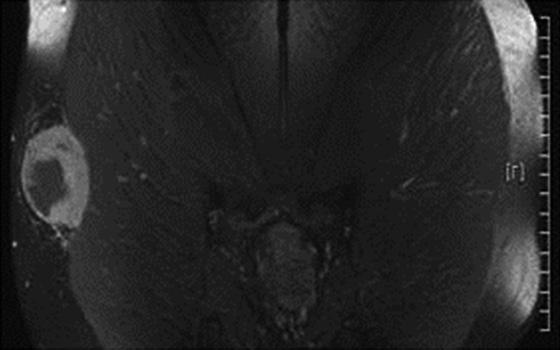 Calcification, hemangioma with phleboliths, osteochondroma A B C Figure 4. Magnetic resonance imagings of leiomyosarcoma.