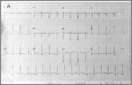 Echocardiogram 훈련된선수혹은엘리트선수의심장초음파는다양할수있음. 경쟁스포츠의선수들은평균 46% 정도의좌심실질량증가. 좌심실이완기말용적은유산소운동을하는선수들에게있어서약 10% 정도증가, 좌심실용적은약 33% 정도가증가. 좌심실중격과후면벽두께는종종남자선수에게서증가되어있지만여자선수에게서는보이지않음.