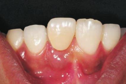 A maxillary right central incisor