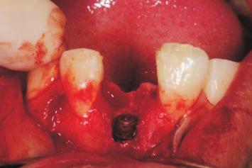 Fig. 4. Intraoral photographs of implant placement.