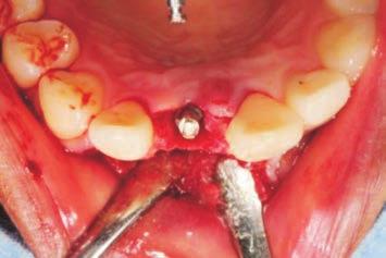 (B) Filling the buccal gap between the alveolar wall and the implant with Osteon (Dentium)