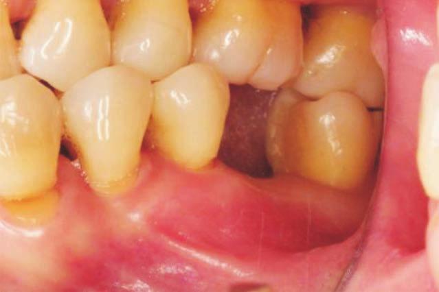 aminopropyl) Carbodiimide in Two Implant