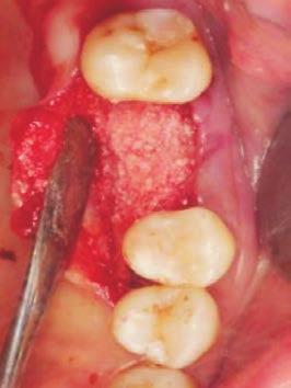 alveolar wall and the implant with Bio-Oss (Geistlich Biomaterials)