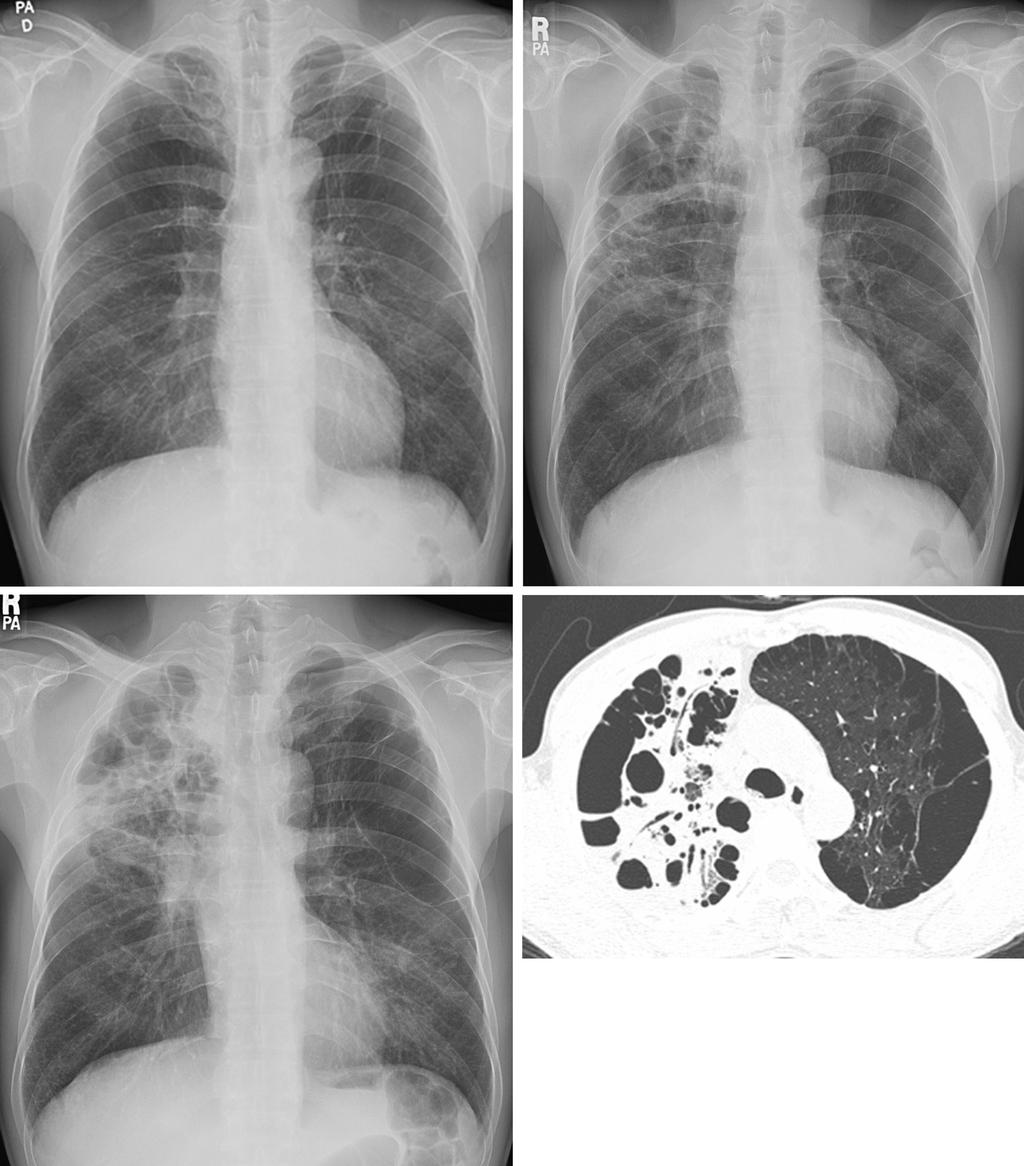 Yu-Ji Lee, et al : Acute pneumonia caused by Mycobacterium intracellulare B A D C Figure 1. A 55-year-old man with M. intracellulare pulmonary disease presenting as acute pneumonia.