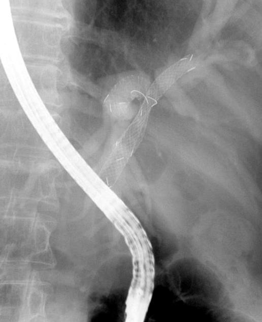 (D) Target site is dilated with 6 8 mm CRE balloon dilator. (E) A metal stent is inserted. 또한 7명 모두에서 성공하였다(우측 담도 기술적 성공률, 100%).