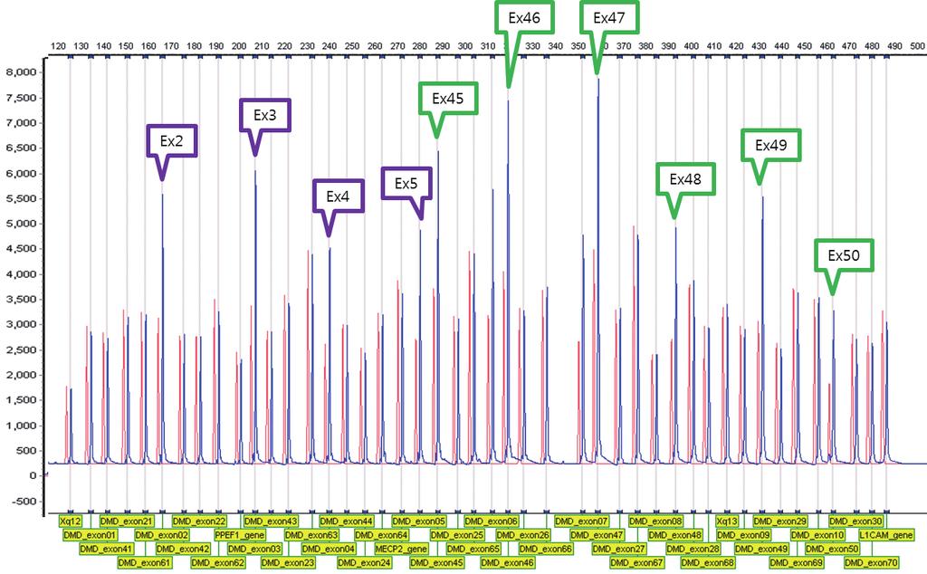 부위의불연속적중복이관찰되었다 (Fig. 1). 각각의중복은모두독립적으로 in-frame으로예측되었다. 환자 2는 5세에발달지연으로시행한근전도검사에서근디스트로피를진단받았으며, 10세부터독립적인일상생활이어려워휠체어에서생활하였다. 이후 20세에호흡약화로호흡재활이필요하여정확한진단을위해 MLPA 검사를시행하였다.