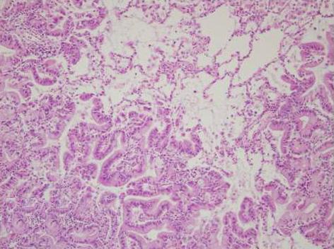 (D) Mucinous adenocarcinoma area in the right middle lobe of the lung (H&E stain, 200). 기낭종과구분이되지않으며때로는단순흉부사진에서관찰되지않을수있다.