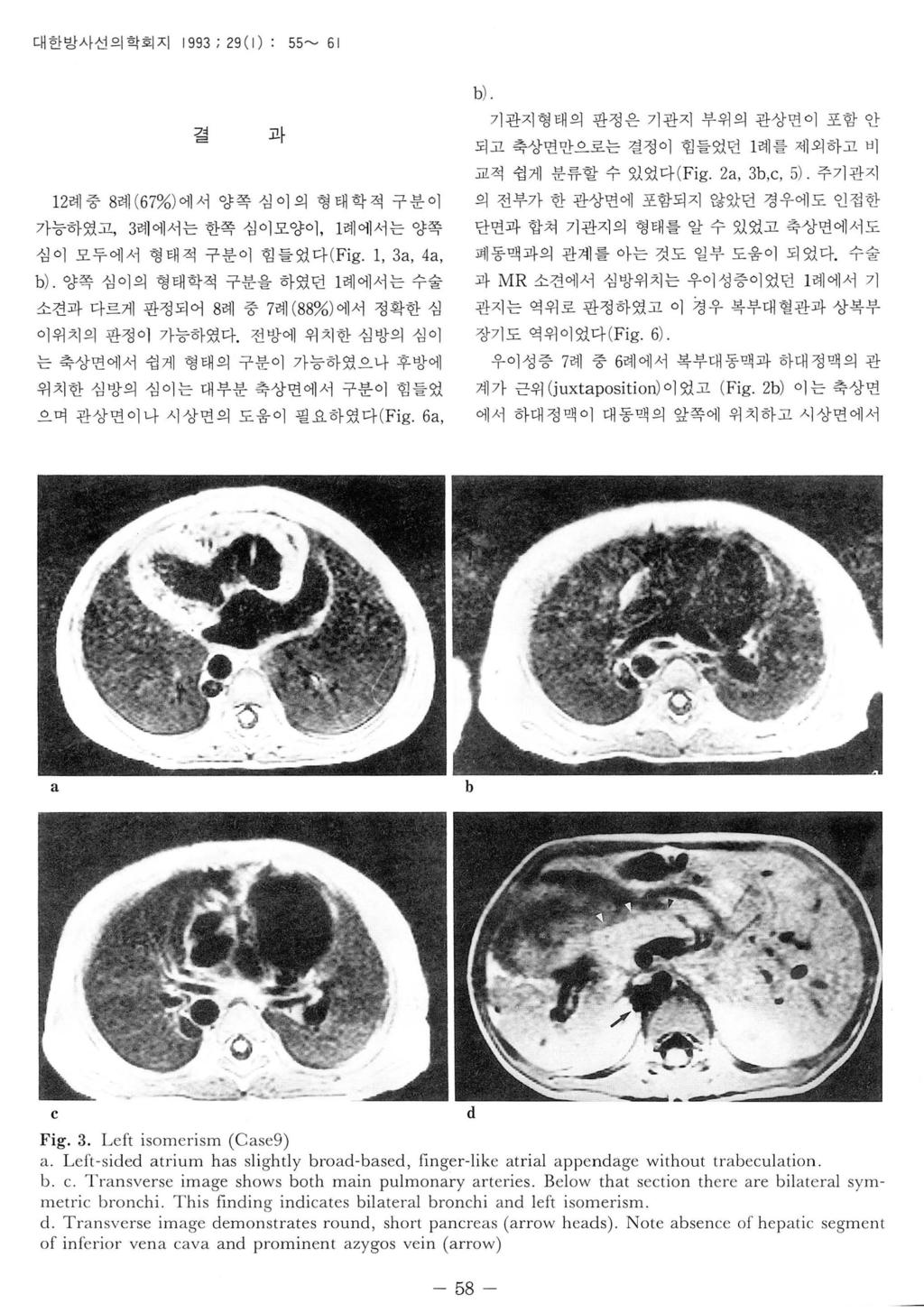 대한방사선의학회지 1993 ; 29 ( 1): 55~ 61 7" <= 과 1 2 례중 8 례 ( 67% ) 에서양쪽심이의형태학적구분이 가능하였고, 3 례에서는한쪽심이모양이, 1 례에서는양쪽 심이모두에서형태적구분이힘들었다 ( F i g. 1, 3, 4, ).