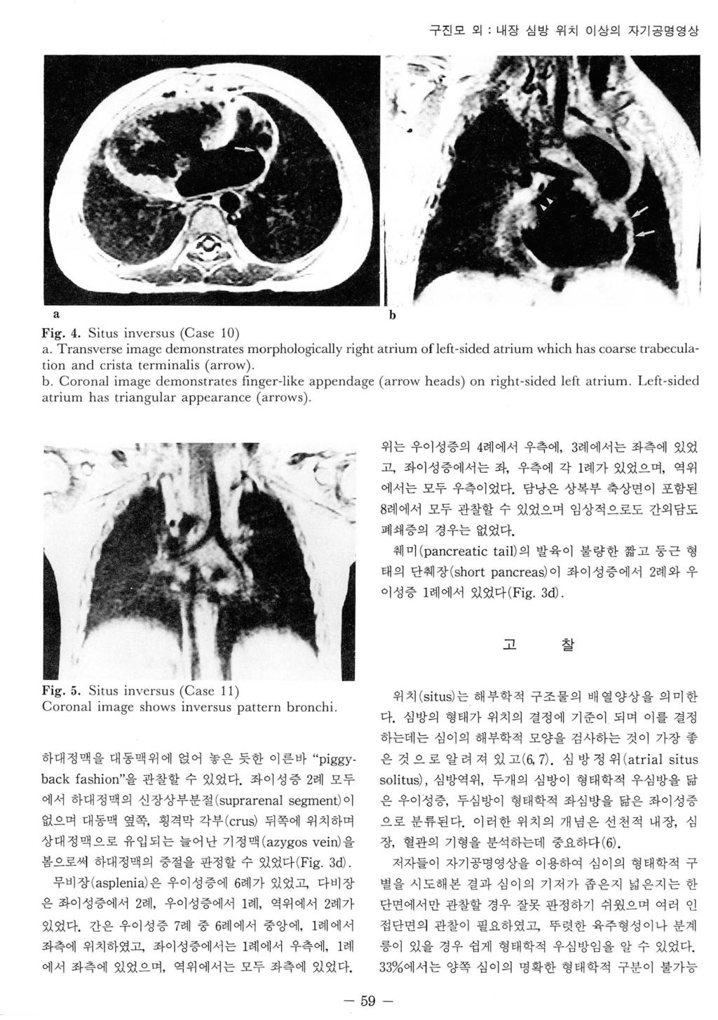 갱구진모외. 내장심방위치이상의자기공명영상 Fig. 4. Situs inversus (Cse 10). Trnsverse imge demonstrtes morphologiclly right trium of!eft- sided trium which hs corse trecultion nd crist terminlis (rrow).