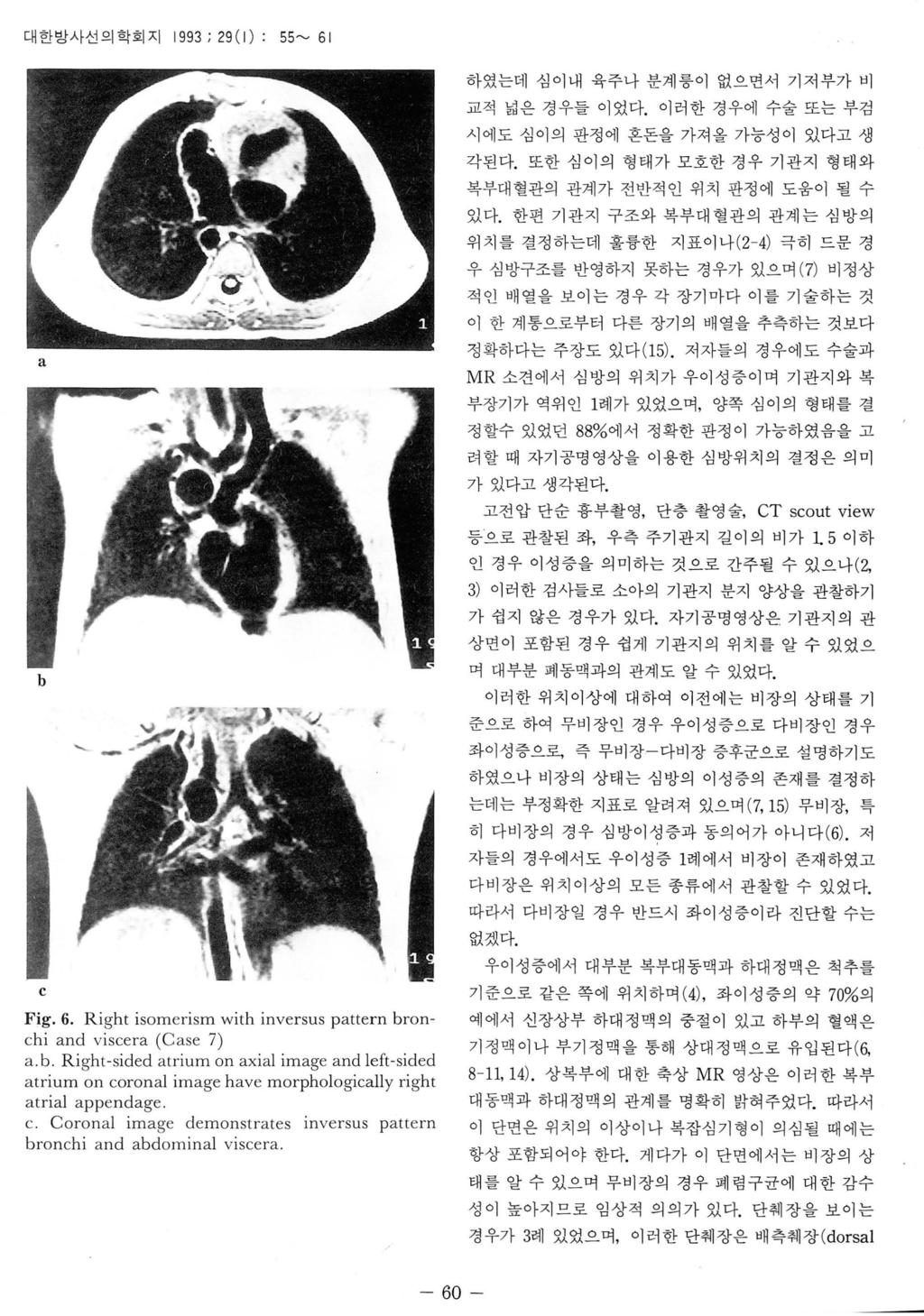 대한방사선의학회지 1993 ; 29 ( 1) : 55~ 6 1 하였는데심이내육주나분계릉이없으면서기저부가비 c Fig. 6. Right isomerism with inversus pttern ronchi nd viscer (Cse 7).