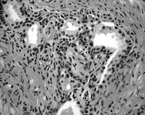 전립선 병리 소견은 1명의 병리과 전문의가 전담하여 분 석하였다. 증세포의 침윤을 보이면서 융합성의 림프 여포를 형성하는 경우로 구분하였다.