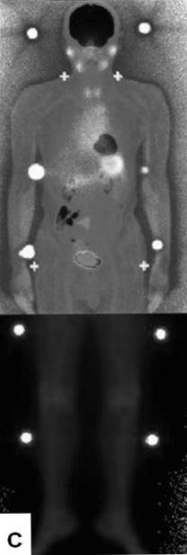 이것은 computed tomography (CT) 나 magnetic resonance imaging (MRI) 등을사용하기힘들던 1970, 1980년대에는큰의미가있었으나, 지금은 CT나 MRI 에서선원의깊이정보를알수있기때문에중요도가줄었다.