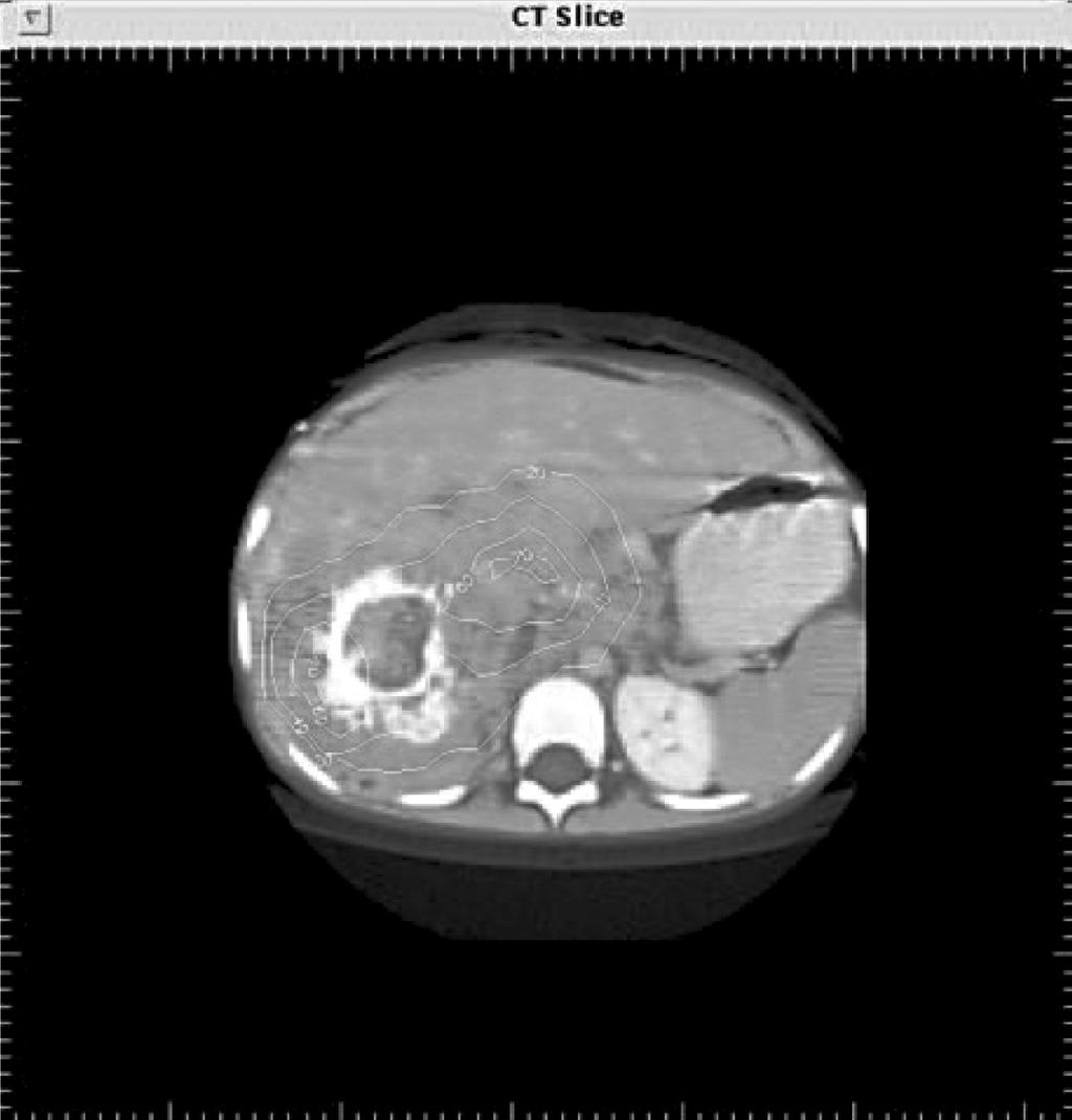 PET는소멸광자 (annihilation photon) 를검출하는것으로 SPECT에비하여우수한민감도를나타내며, 정량화방법도잘확립되어있다. 그러나임의동시발생 (random coincidence) 신호의제거, 불응시간고려, 감쇠보정, 산란보정등의기술적사항이필요하다. PET 영상을선량평가에사용하기위하여치료에사용되는동위원소와같은원소를사용하는것이이상적이다.