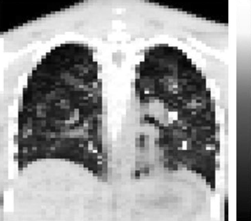 Ilhan Lim Fig. 4. I-124 PET imaging based dosimetry. 17) Representative coronal slices of absorbed dose (D) maps of two different data sets: torso (measured) (A) and head (modeled) (B).