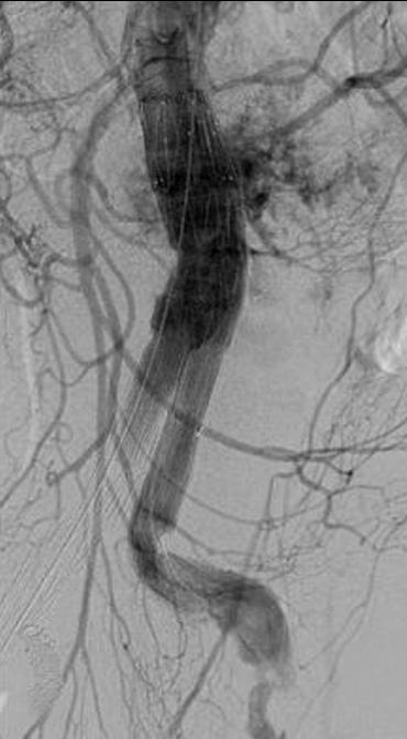 (D) Follow-up CT angiogram shows abdominal aortic and the left renal artery reconstructions.