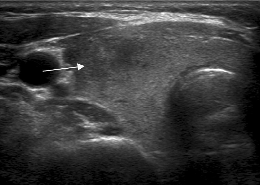 view (C). The Left lobe showed homogeneous parenchyma in transverse view (D) during a first visit. Table 1.