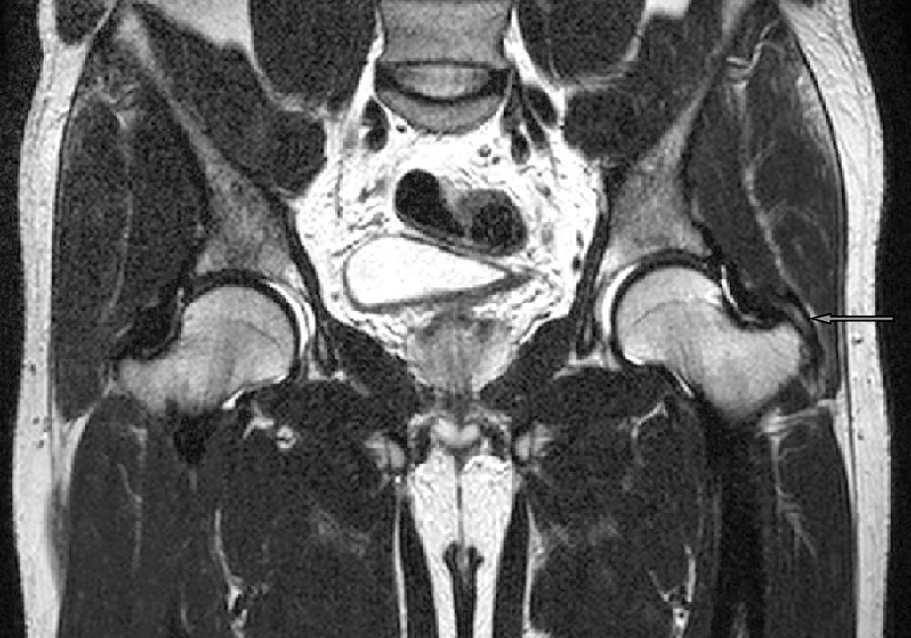 SR Yi, et al. Diagnostic Utility of MRI with Problems in Cross-Legged Posture 악화, 유지, 호전으로 구분하여 확인하였고 타 병원 방문을 포함 한 추가적인 진단이나 치료를 받았는지를 확인하였다. 통계적 의미는 없었다. 이학적 검사상 압통이 관찰된 경우는 33예(24.