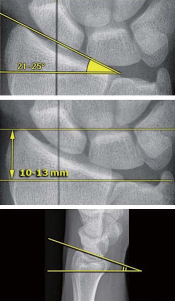 Jae Hoon Lee, Surgical Indications for Distal Radius Fractures 요측에서후척측으로이동하게되며중수근관절 (midcarpal joint) 이굴곡함으로써보상하려는경향이발생하고이는중수근관절에서통증성활액막염과후방게재불안정 (dorsal intercalary segment instability, DISI)