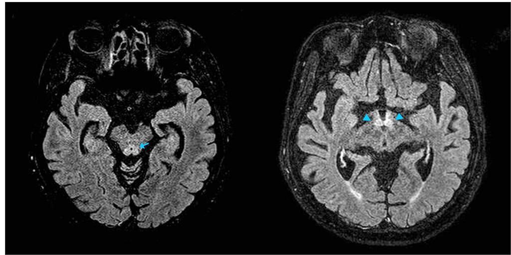 A B Figure 2. Brain fluid attenuated inversion recovery magnetic resonance image.