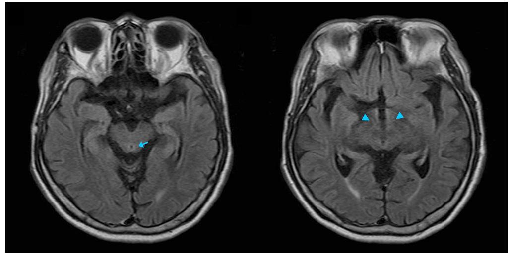 - 황문원 문성혁 : 베르니케 뇌병증과 내사시 - A B Figure 4. Brain fluid attenuated inversion recovery magnetic resonance image.