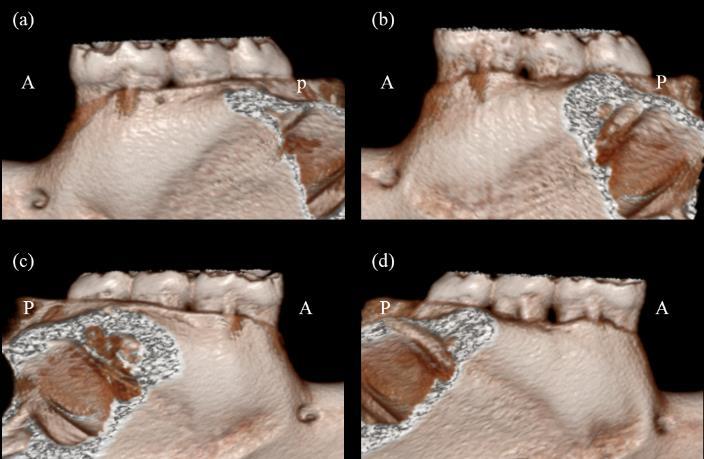 Figure 5. In vivo micro-ct 3D reconstructed images of the mandible at the buccal side. Images taken immediately after ligation, on the left mandible (a) and right mandible (c).