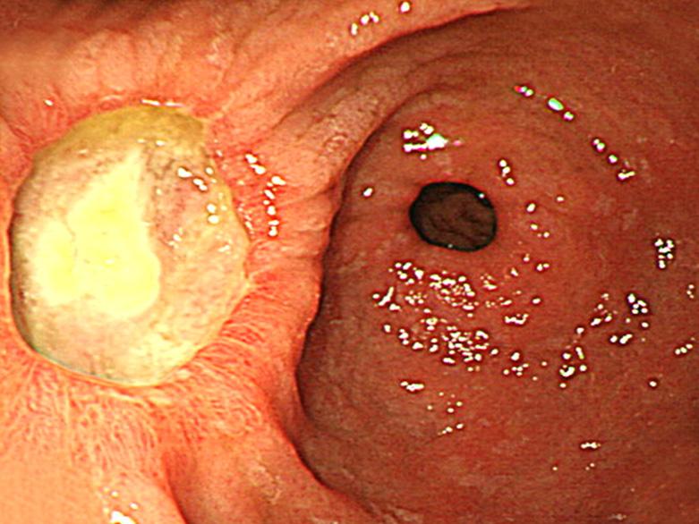 (B) Six months after endoscopic mucosal resection (EMR), there remains a huge ulcer at the previous EMR site. The pathology was negative for malignancy.