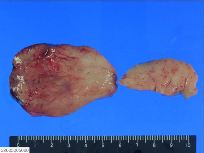 대한내분비학회지 : 제 22 권제 6 호 2007 4시간공복후저혈당이생겼고, 이때측정한 plasma glucose 36 mg/dl, insulin 9.93 pmol/l (0-208), C-peptide 0.18 ng/ml (0.