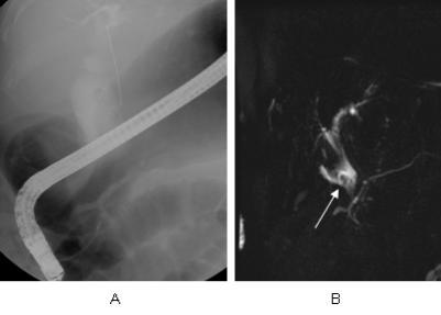 of stone in the common bile duct and the dilated common channel. Fig. 9.