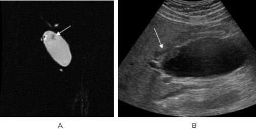 Fig. 11. A 40-year-old male with a type IA choledochal cyst and a type Ia AUPDB combined with choledochal cyst cancer. A. MRCP image shows a cystic dilatation of common bile duct without intrahepatic duct dilatation, and an irregular shaped low signal intensitic lesion (arrow) inside of the cyst.