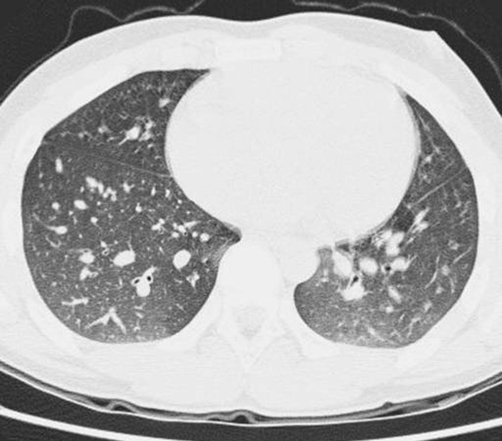 A B Fig 3. Patient 8. A 9-year-old-male presented with dyspnea, cough, and hoarseness.