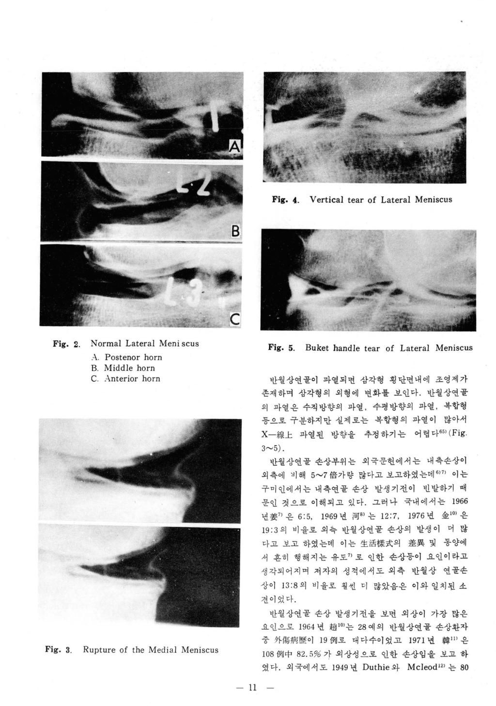 Fig. 4. Vertical tear of Lateral Meniscus Fig. 2. Fig. 3. Normal Lateral Meni scus.-\. Postenor horn B. Middle horn C..-\nterior horn Rupture of the Medial Meniscus Fig. 5.