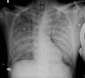 Tuberculosis and Respiratory Diseases Vol. 59. No. 6, Dec. 2005 (A) (B) Figure 1. Chest X-ray in a 44-year-old man who inhaled nitric acid fumes. A.