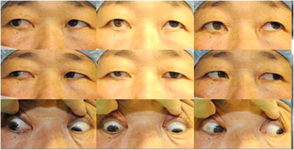 - 박종혁 전루민 : 외안근에 발생한 고립형 근농양 - A B Figure 1. Initial examination. (A) M ild limitation on up-gaze and obvious limitation on down-gaze in the right eye was confirmed.