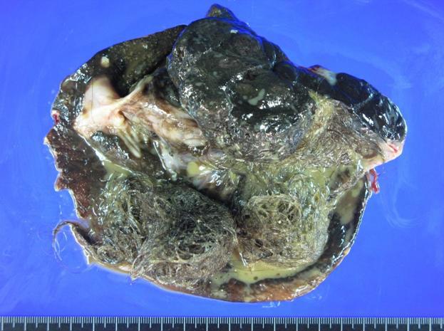 대한산부회지제 53 권제 9 호, 2010 A B C D E Fig. 2. (A) Gross appearance of cystic tumor of left ovary.