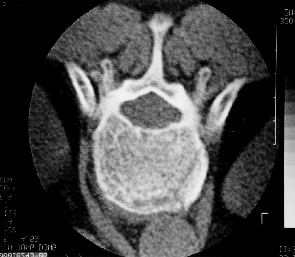 유영상 신재학 김일만 B A Fig. 1. Thoracic (T12) osetoporotic collapse fracture. Axial CT obtained before (A) and after (B) percutaneous vertebroplasty by bilateral transpedicular approach.
